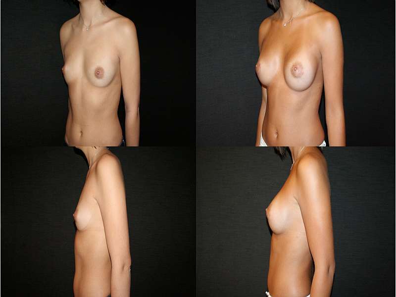 Ženské prsa před a po plastice