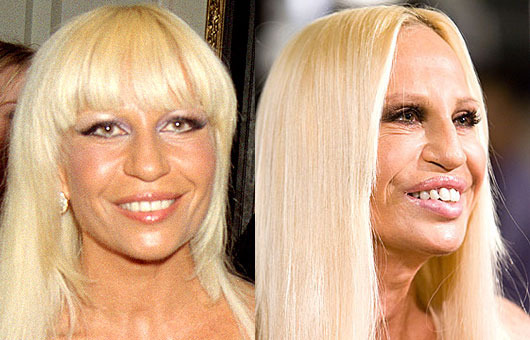 Donatella Versace před a po plastice 